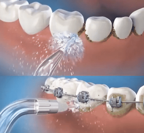 OralFlow® - Irrigador bucal - Limpieza profunda – Homexpress
